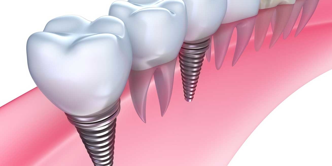 https://www.nkdental.galimap.com/img/slider/implant.jpg